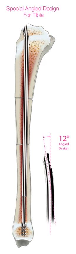 High Bend Tibia Nail at Best Price in Vasai | Om Surgical